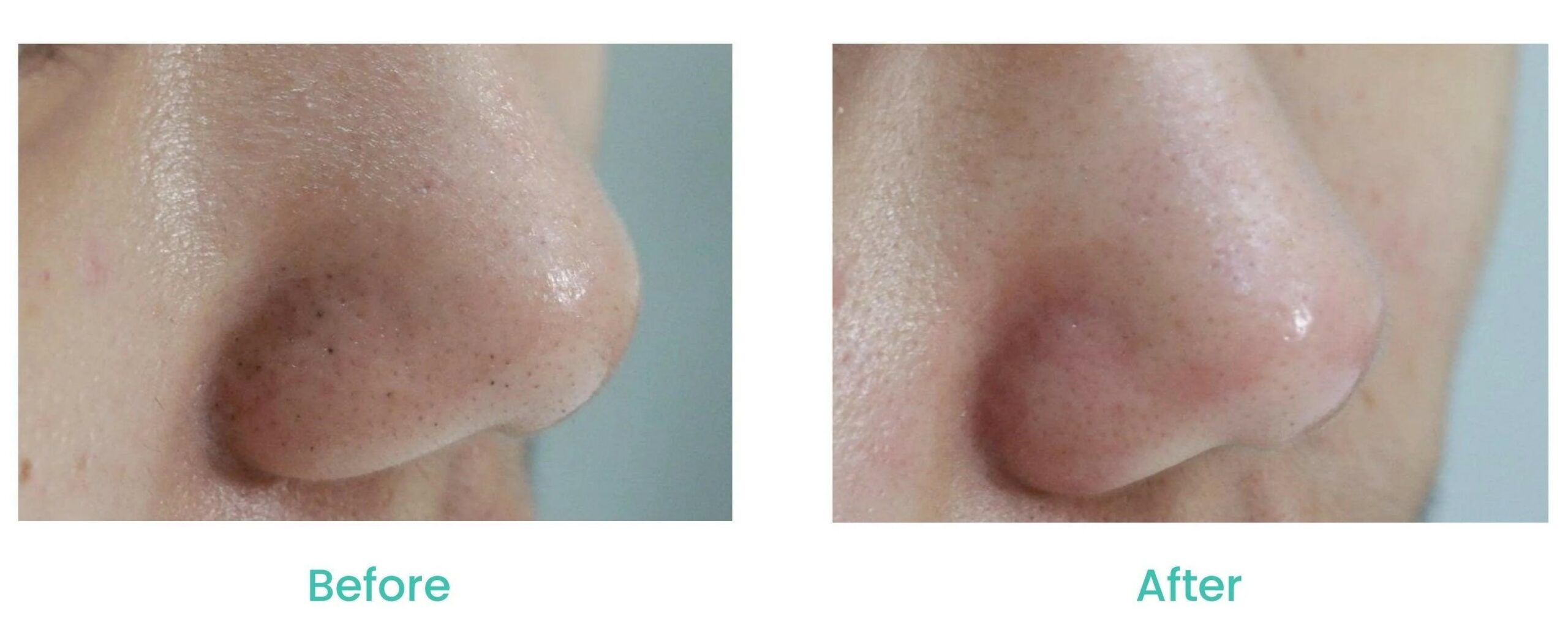 asterspring acne treatment detox clearing therapy results