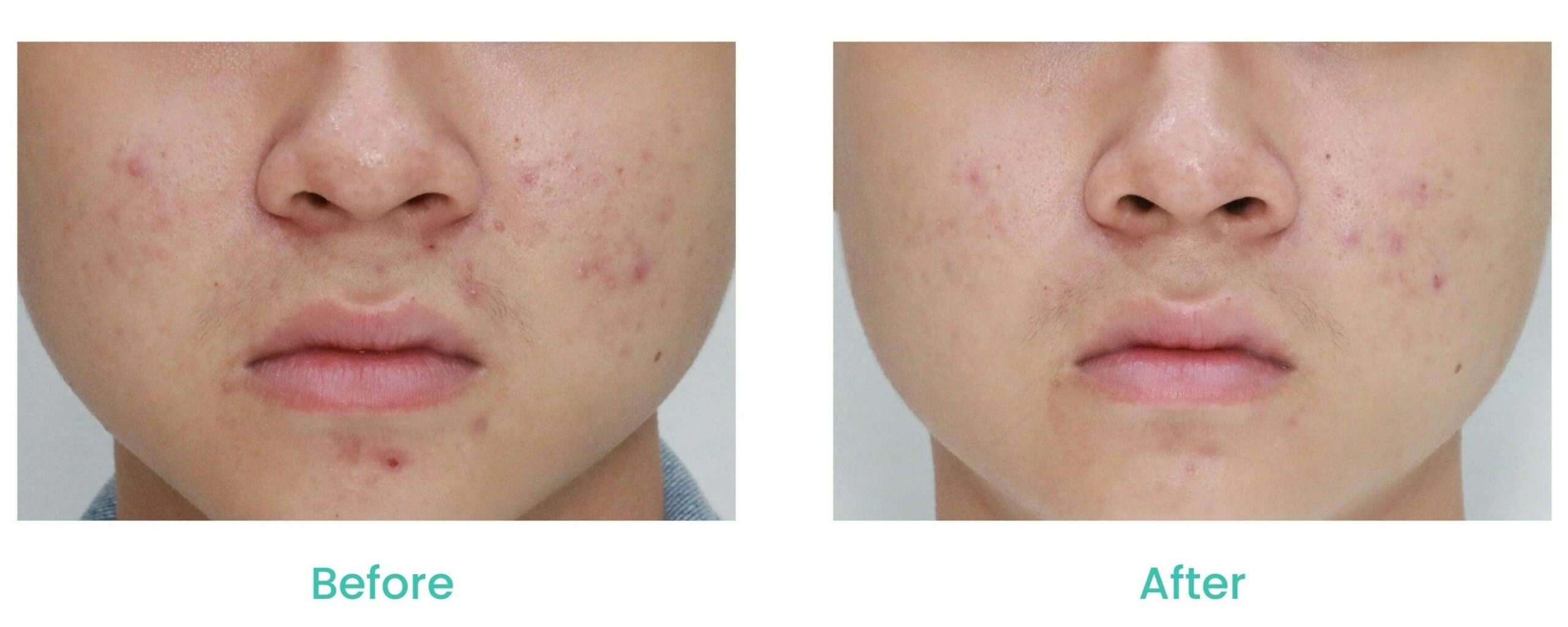 asterspring acne treatment detox clearing therapy