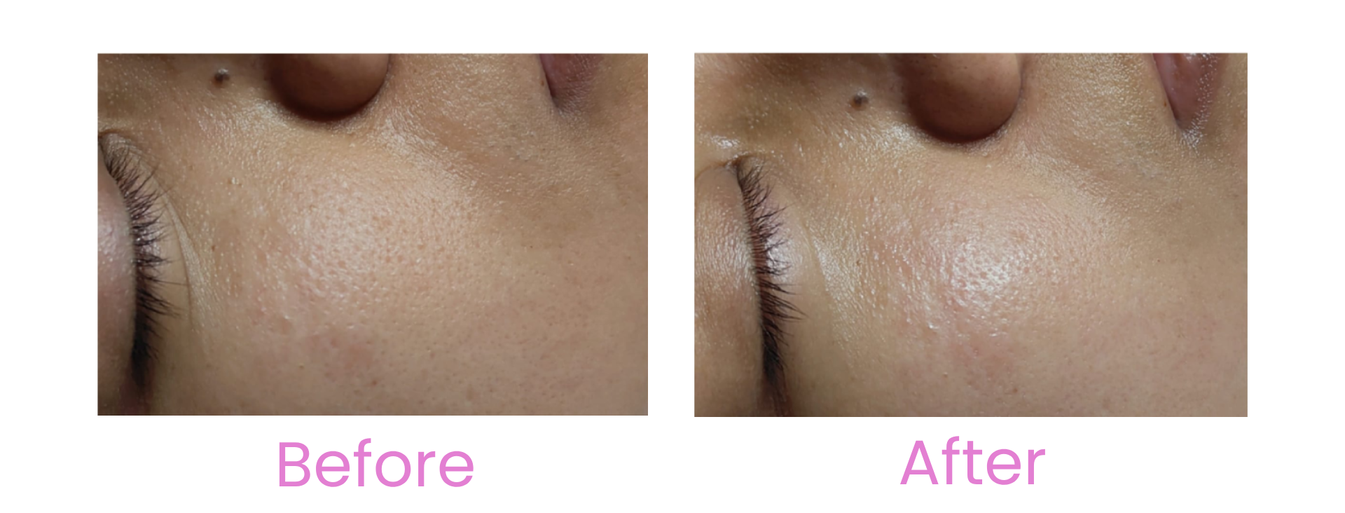 Asterspring singapore age reversal collagen treatment before & after